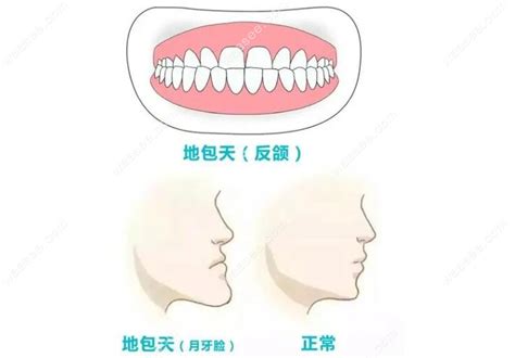 地包天牙齒|難看的「地包天」該如何治療？